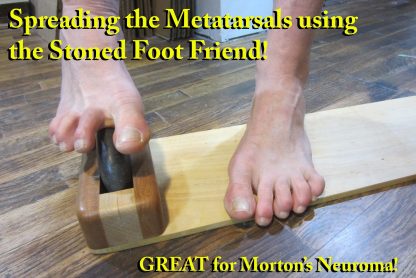 The Stoned Foot friend massage tool spreading the metatarsals for Morton's Neuroma!